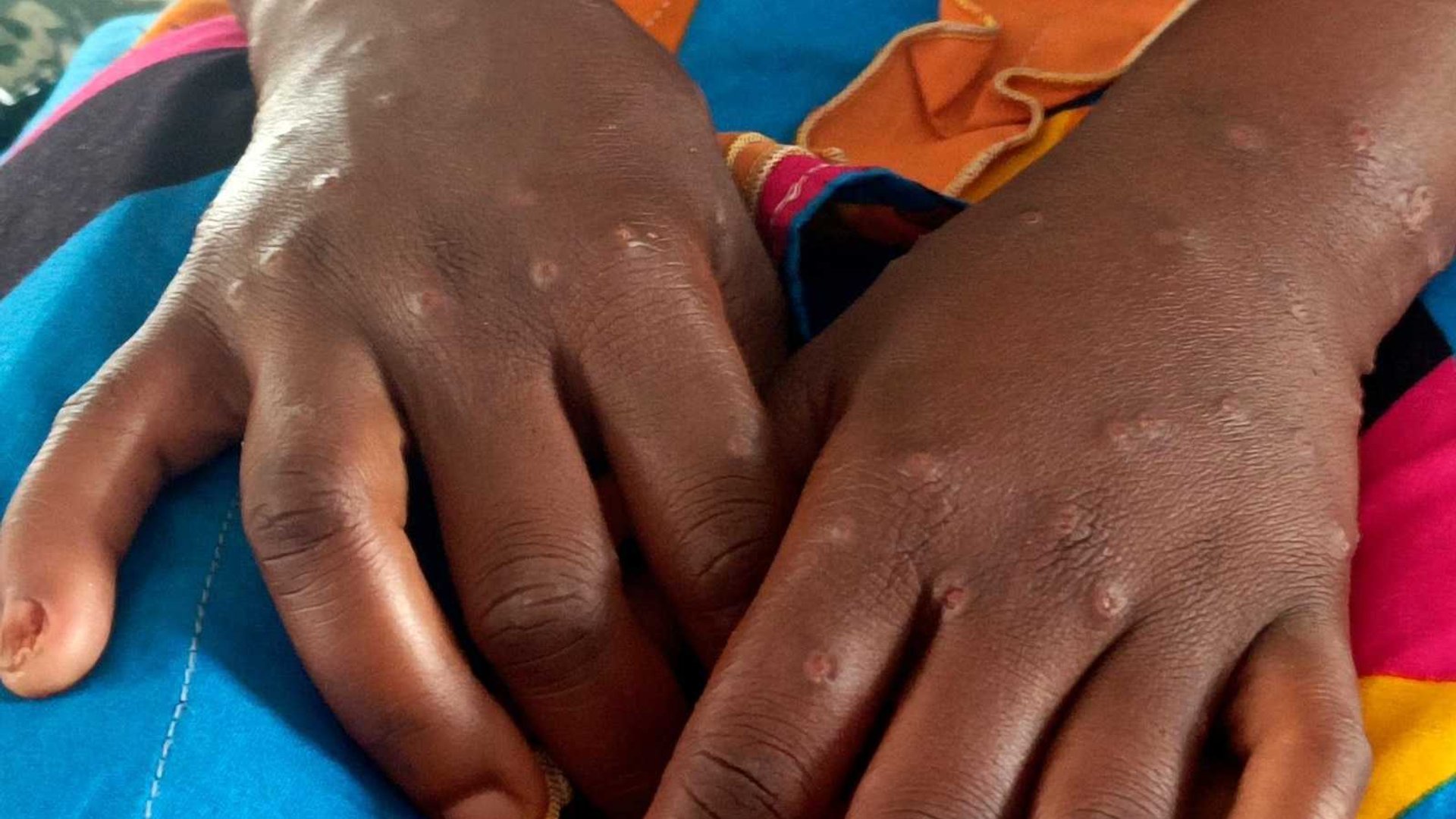 US Aid Cuts Cripple Africa's Disease Response Capacities, Health Chief Warns