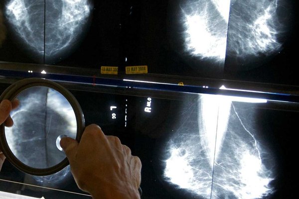 Alarming Rise in Early-Onset Cancer: Study Reveals Key Types Surging Under Age 50